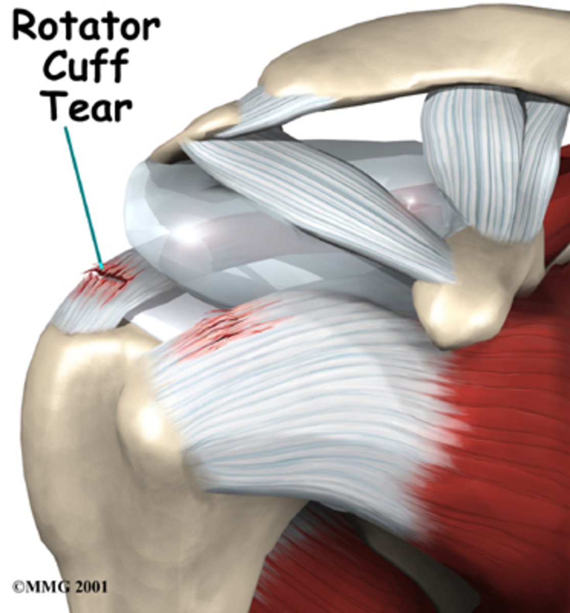 Rotator cuff tear